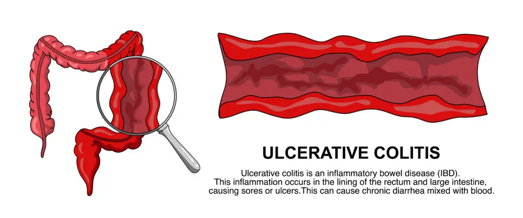 ulcerative colitis and social security disability