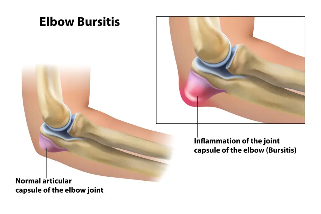 Elbow Bursitis in Texas Workers’ Compensation