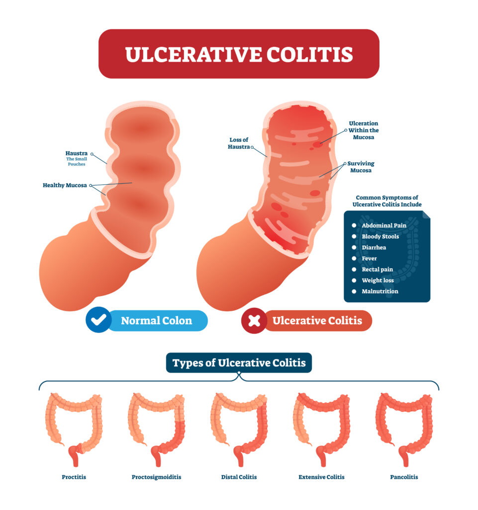 ulcerative colitis and social security disability