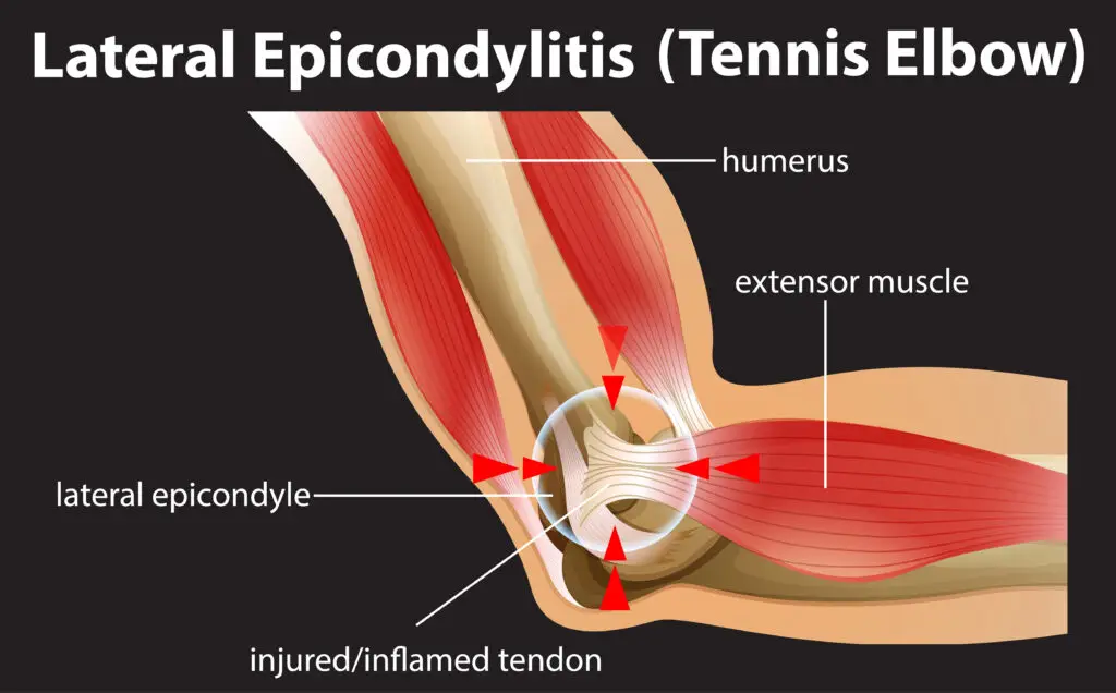 Lateral Epicondylitis in Texas Workers’ Compensation