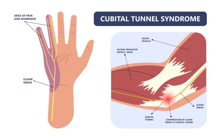 Cubital Tunnel Syndrome in Texas Workers’ Compensation
