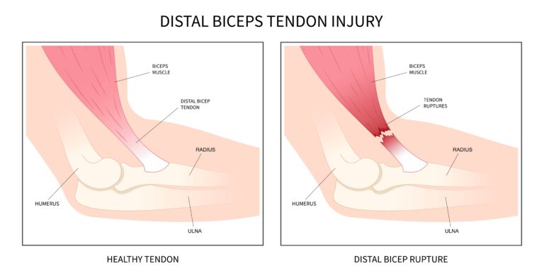 Distal Biceps Tendon Tears in Texas Workers’ Compensation