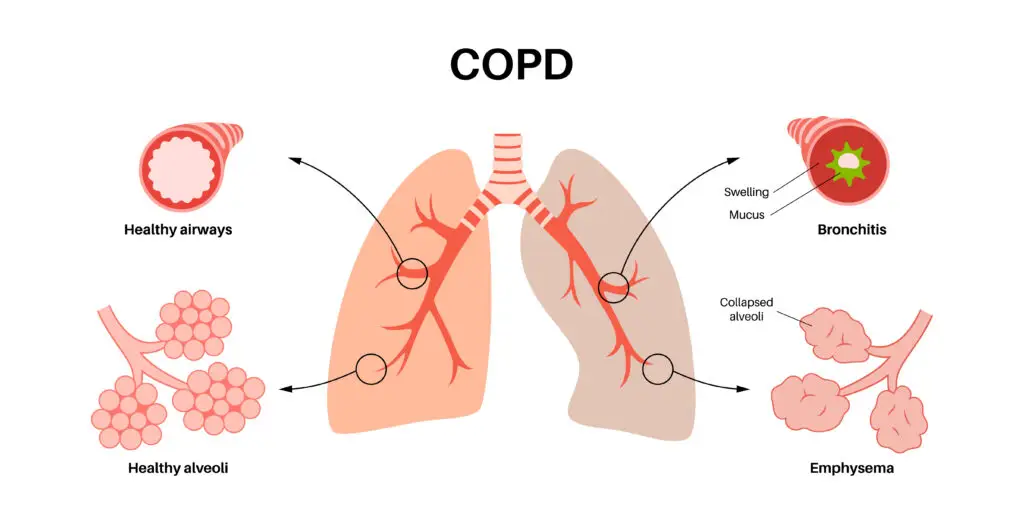 residual functional capacity for COPD