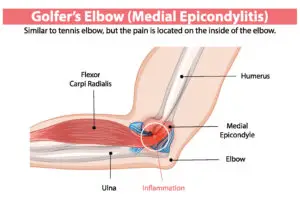Medial Epicondylitis in Texas Workers’ Compensation