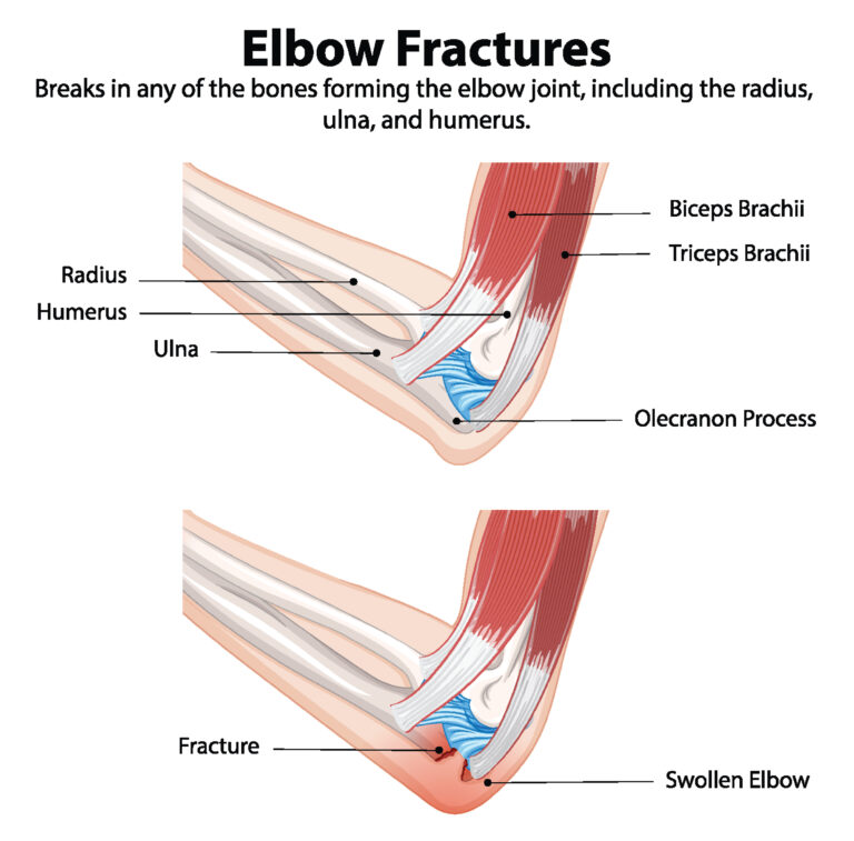 Elbow Fractures and Dislocations in Texas Workers’ Compensation