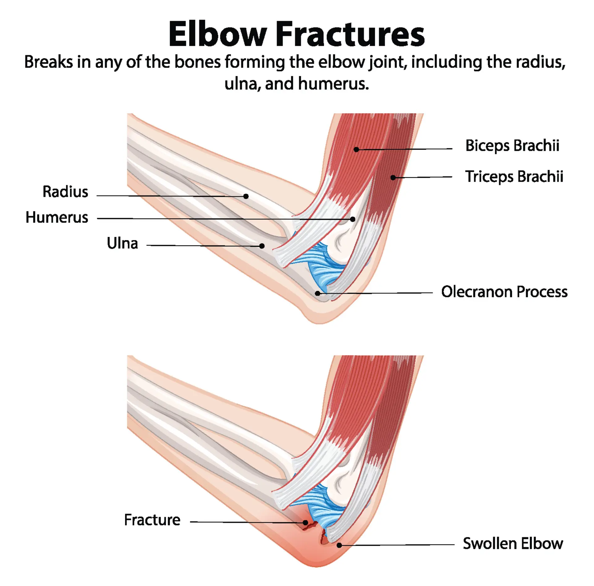 Elbow Fractures and Dislocations in Texas Workers’ Compensation