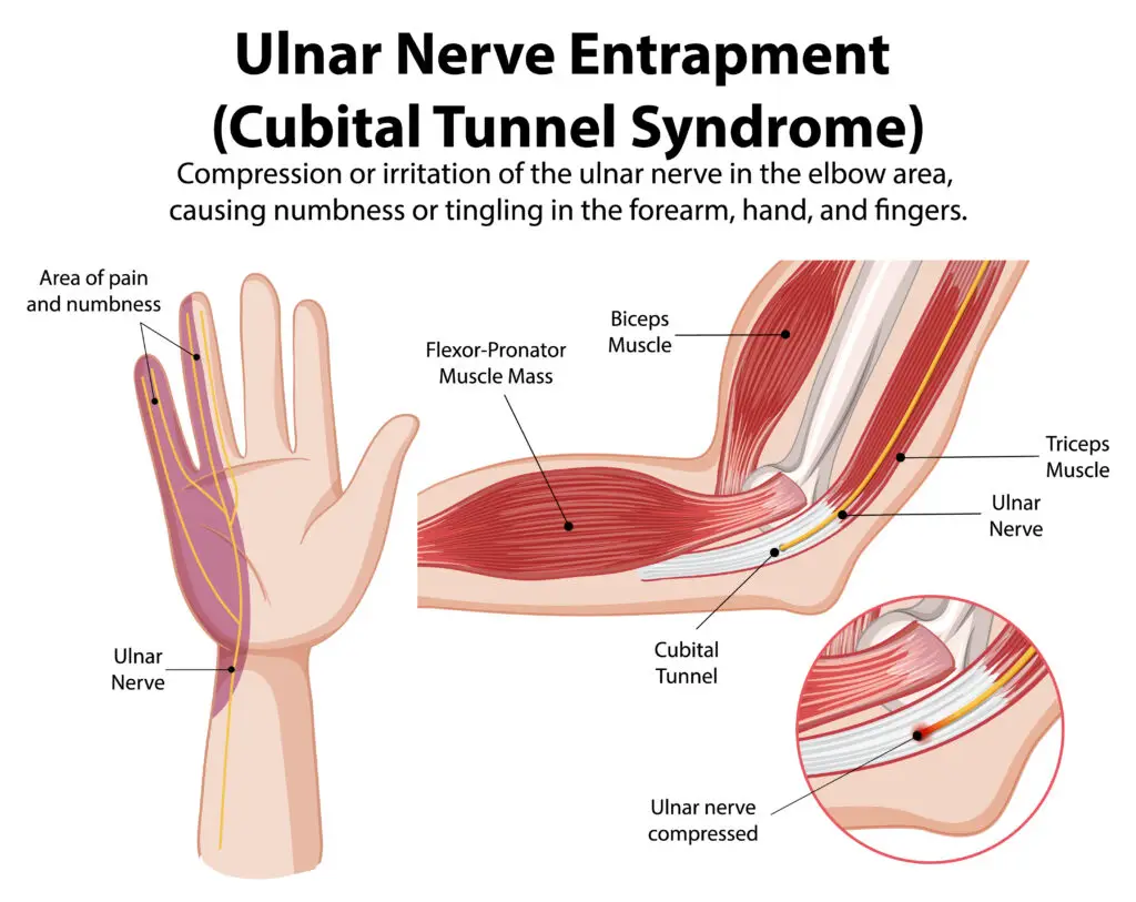 Ulnar Nerve Injuries in Texas Workers’ Compensation