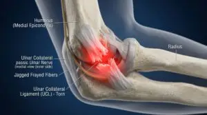 Ulnar Collateral Ligament Sprains in Texas Workers’ Compensation