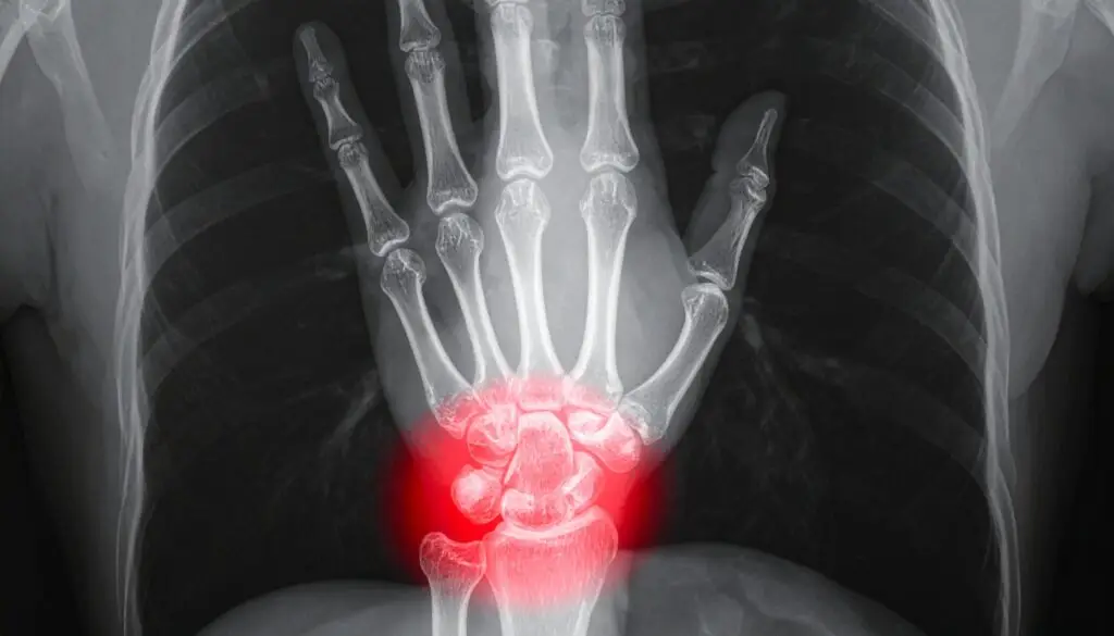 Ulnar Impaction Syndrome in Texas Workers’ Compensation