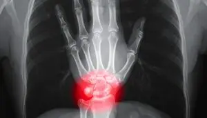 Ulnar Impaction Syndrome in Texas Workers’ Compensation