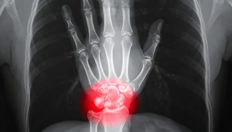 Ulnar Impaction Syndrome in Texas Workers’ Compensation