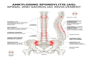 Ankylosing Spondylitis and Social Security Disability