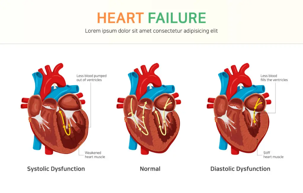 residual functional capacity for heart failure SSDI