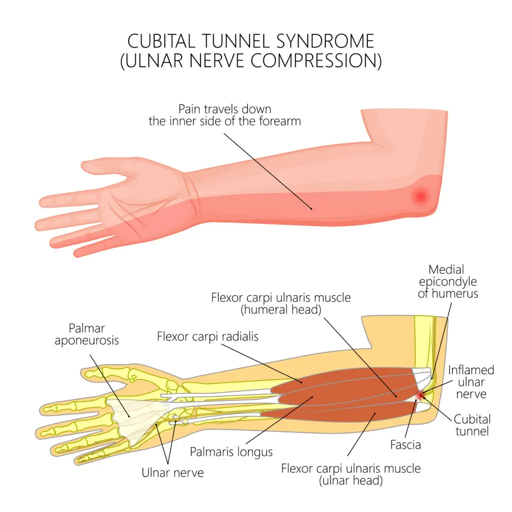 Ulnar Nerve Compression Injuries in Texas Workers’ Compensation
