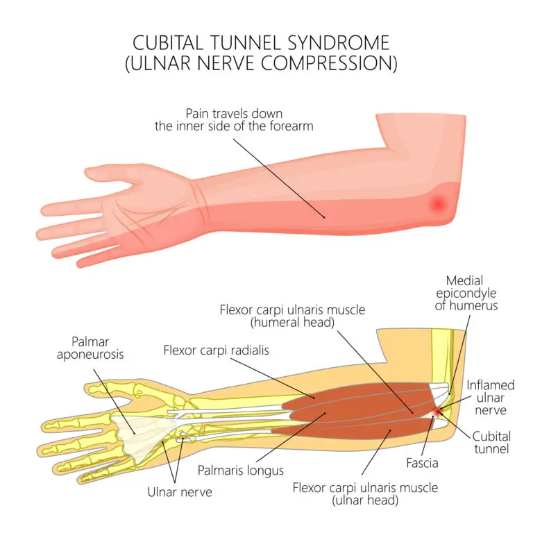 Ulnar Nerve Compression Injuries in Texas Workers’ Compensation