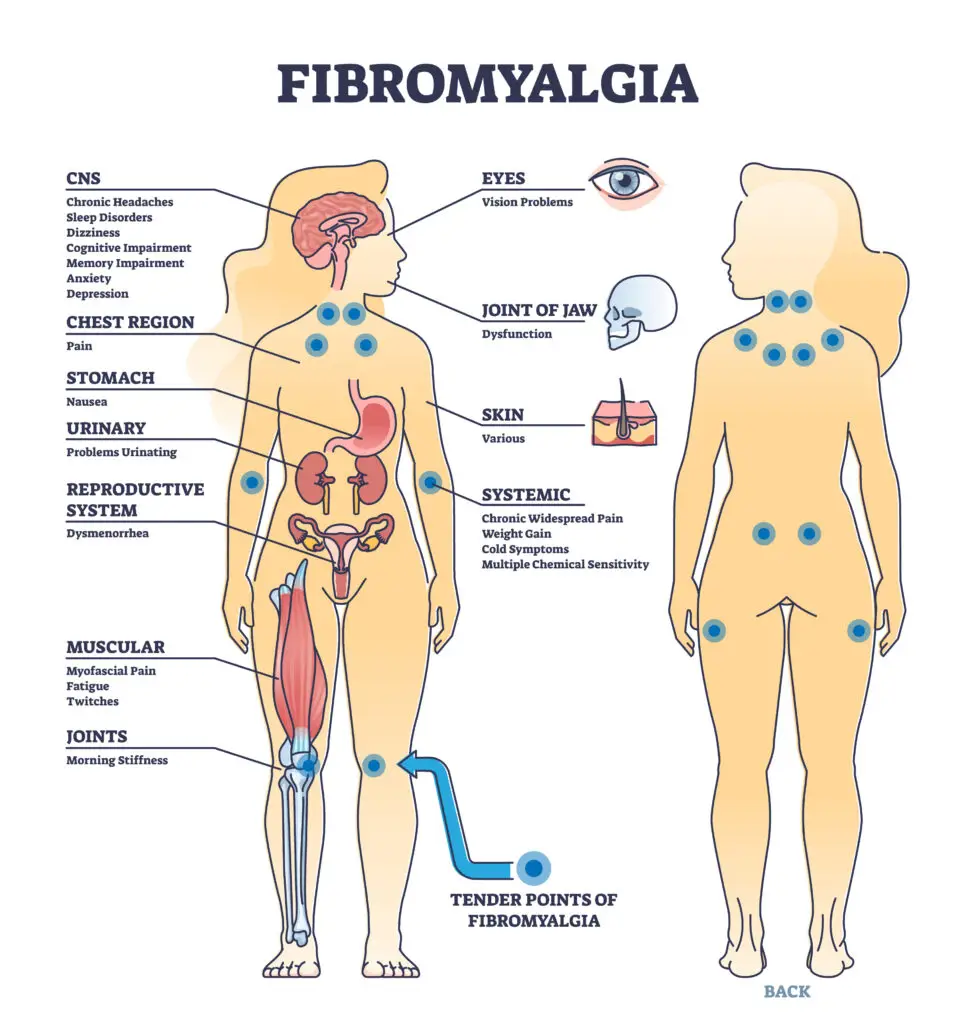 residual functional capacity fibromyalgia SSDI