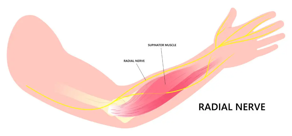 Radial Nerve Compression in Texas Workers’ Compensation