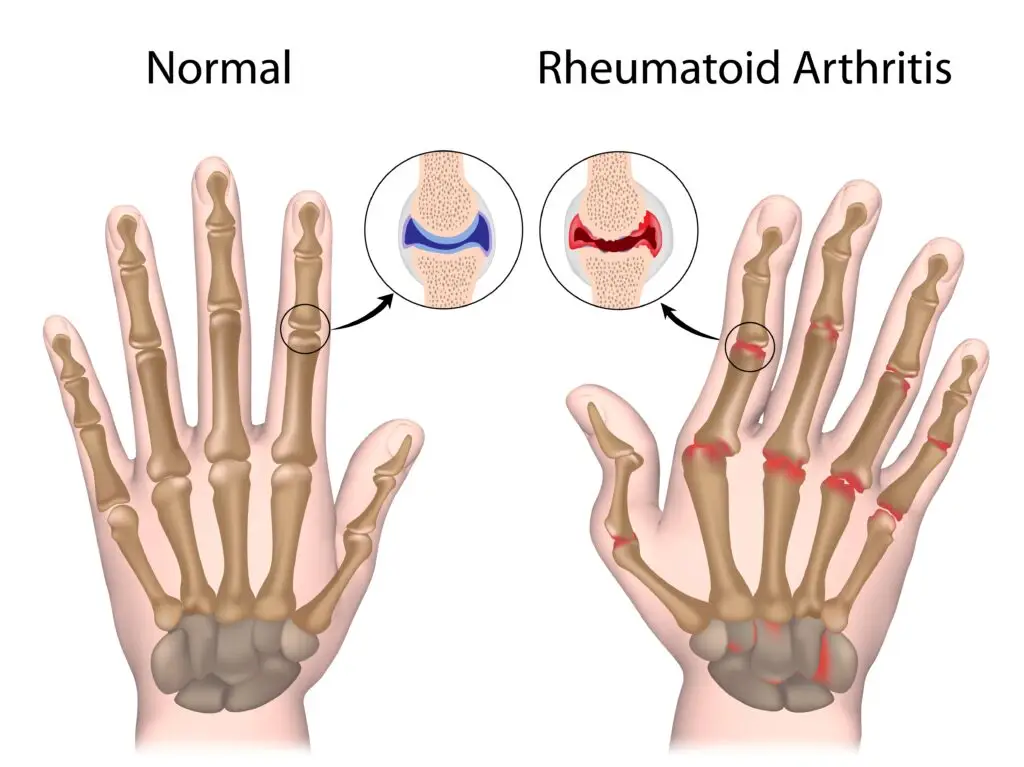 can I work with rheumatoid arthritis