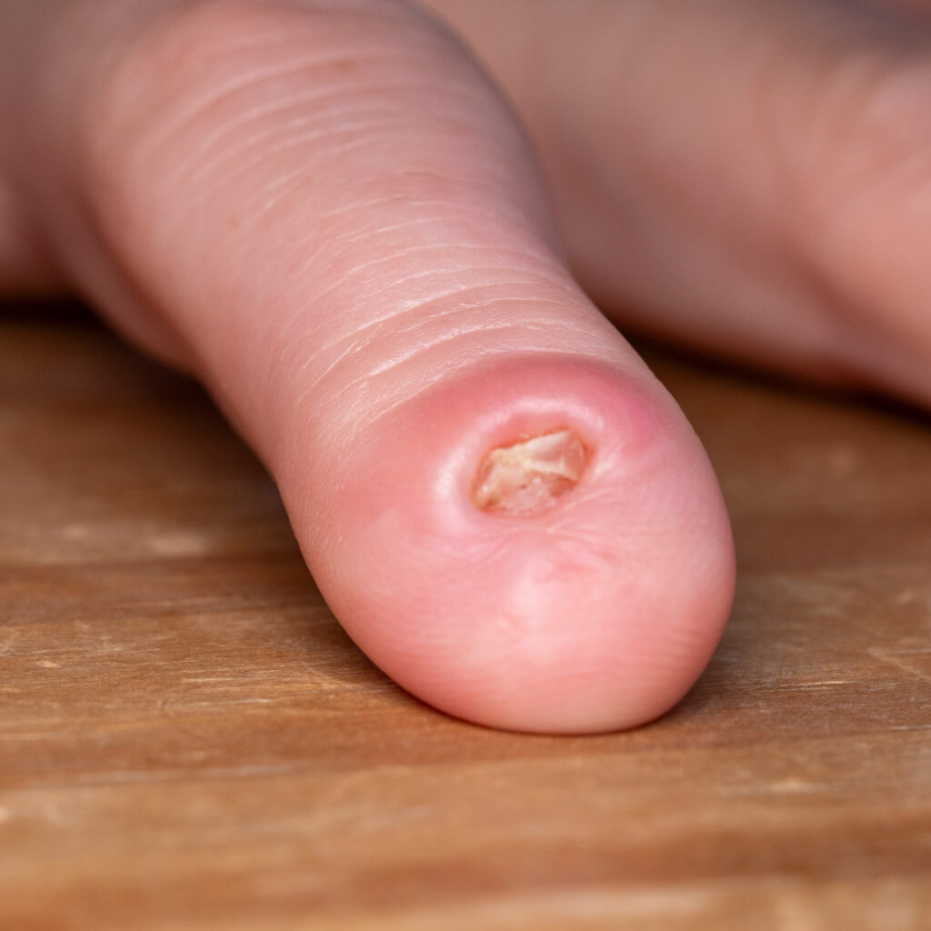 Finger Amputations in Texas Workers’ Compensation