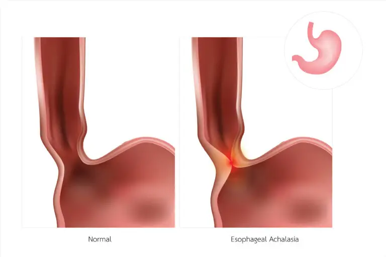 Achalasia and Social Security Disability