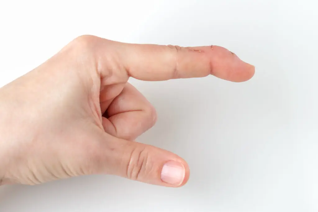 Boutonnière Deformity in Texas Workers’ Compensation