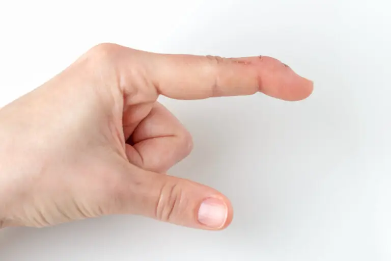 Boutonnière Deformity in Texas Workers’ Compensation