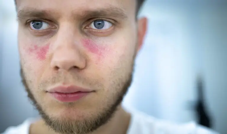 can I work with lupus