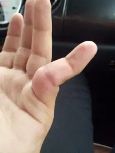 Finger Dislocations in Texas Workers’ Compensation