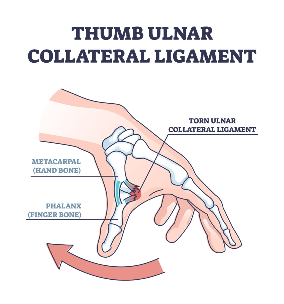 Thumb UCL Tears in Texas Workers’ Compensation