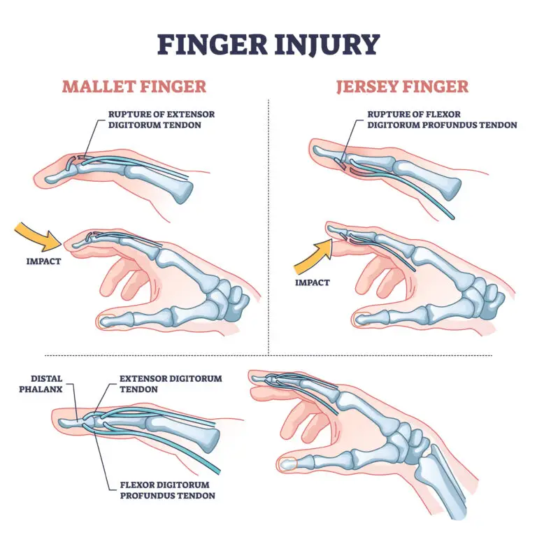 Avulsion Fractures in Texas Workers’ Compensation