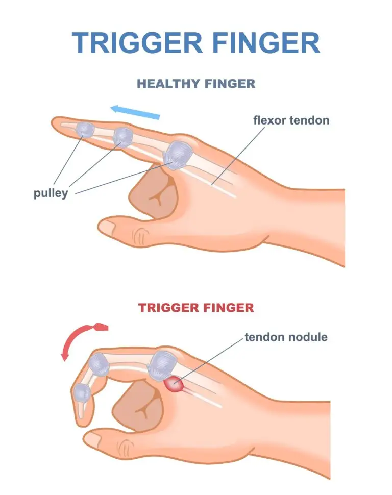 Trigger Finger Injuries in Texas Workers’ Compensation