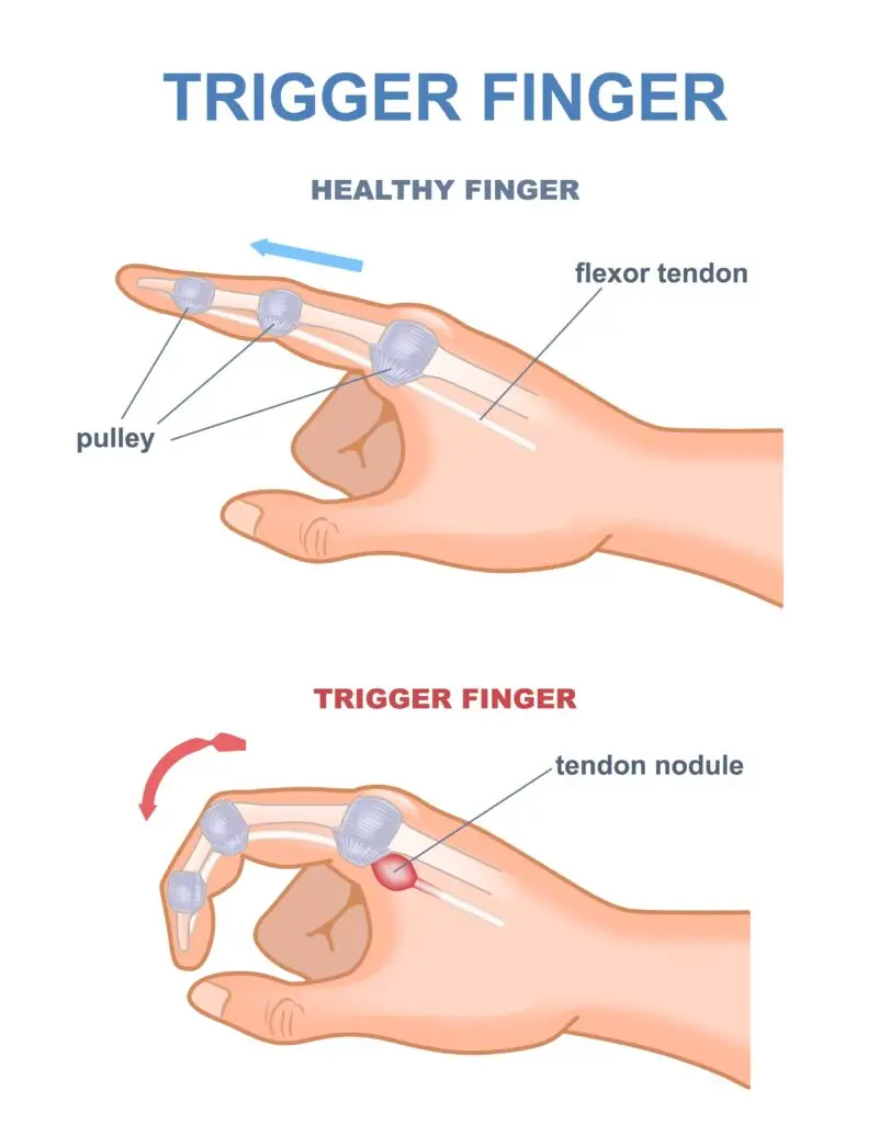 Trigger Finger Injuries in Texas Workers’ Compensation