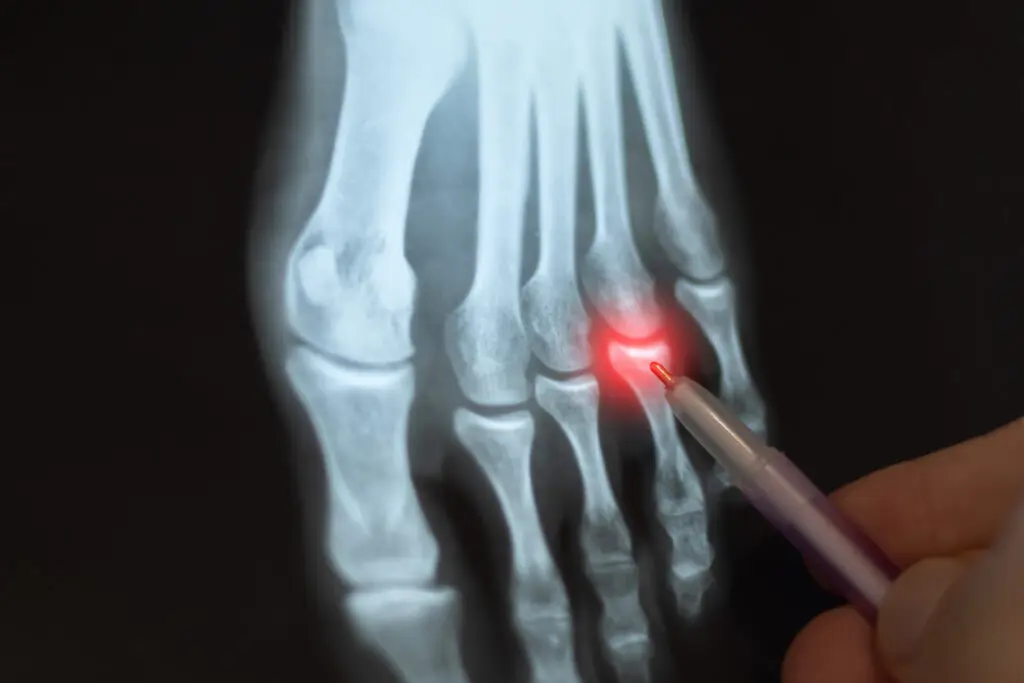 Phalangeal Fractures in Texas Workers’ Compensation