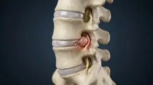 Causation Letters for Lumbar Disc Herniations in Texas Workers’ Compensation