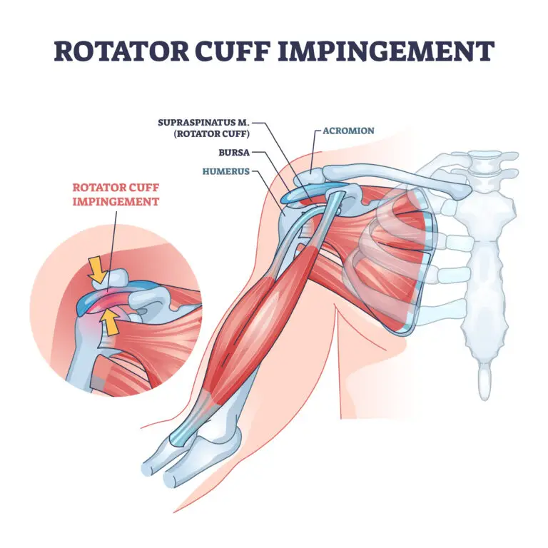Shoulder Impingement Syndrome in Texas Workers' Compensation