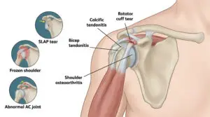 Biceps Tendon Tears in Texas Workers’ Compensation