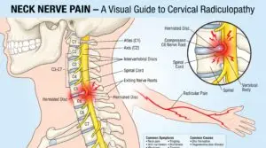 Cervical Radiculopathy in Texas Workers' Compensation