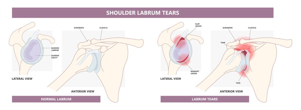 Labral Tears in Texas Workers’ Compensation