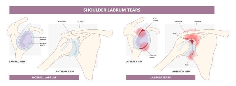 Labral Tears in Texas Workers’ Compensation