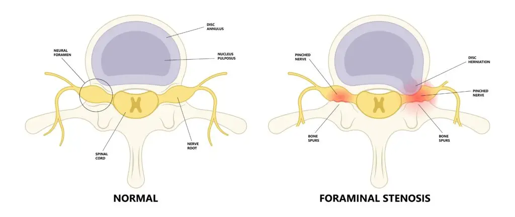 Cervical Foraminal Stenosis in Texas Workers' Compensation