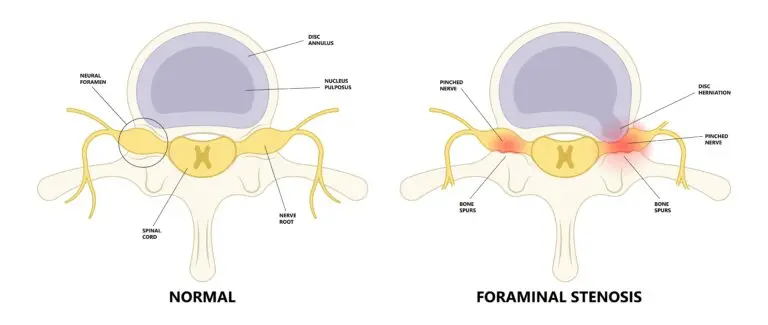 Cervical Foraminal Stenosis in Texas Workers' Compensation