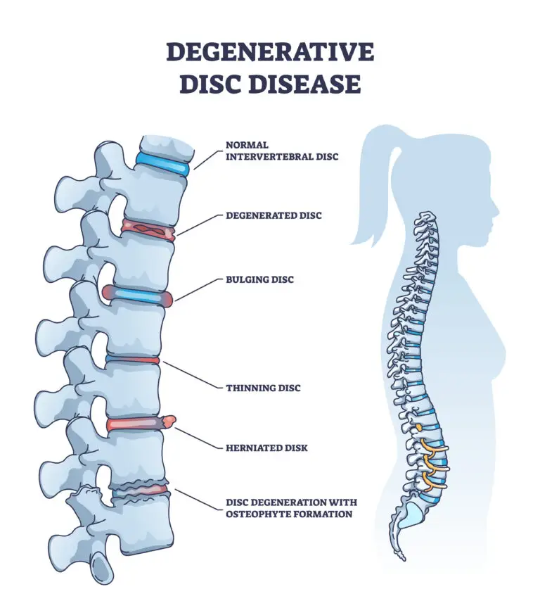 Cervical Degenerative Disc Disease in Texas Workers' Comp