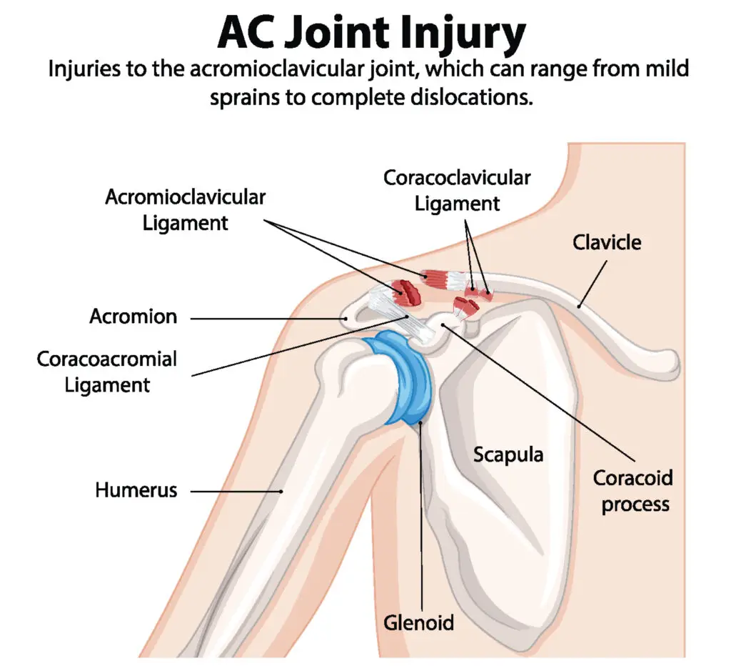 AC Joint Sprains in Texas Workers' Compensation