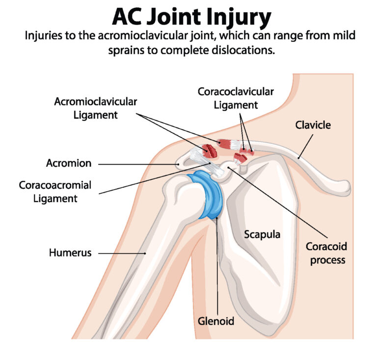 AC Joint Sprains in Texas Workers' Compensation
