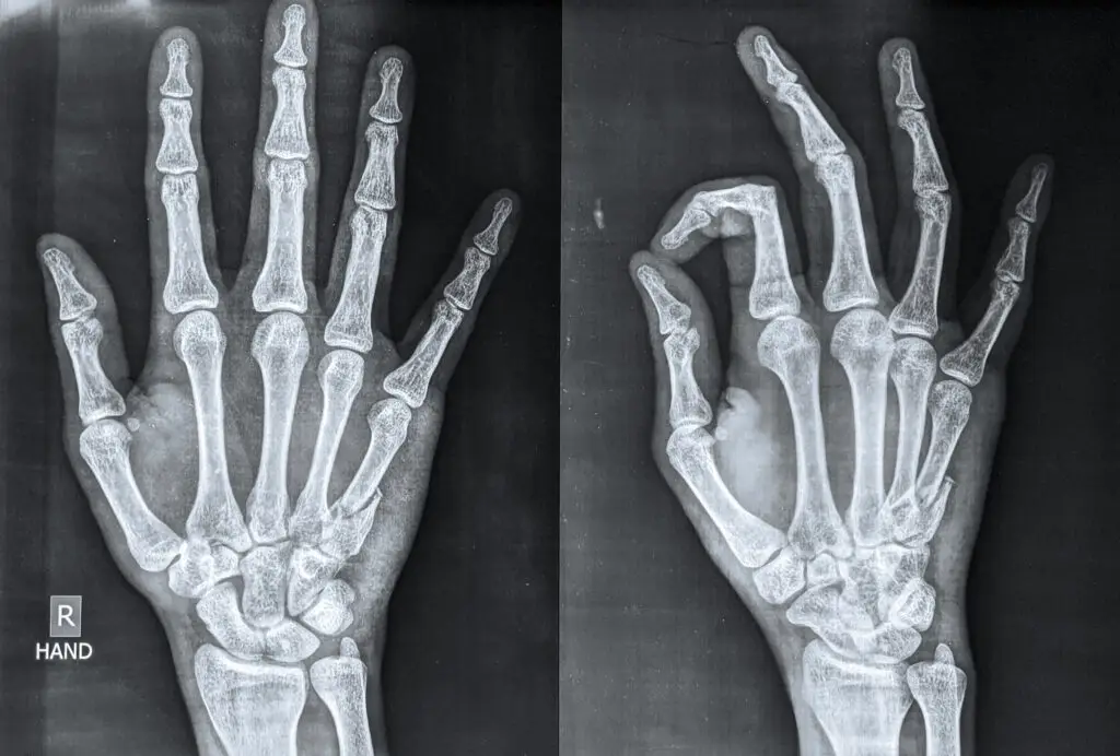 Metacarpal Fractures in Texas Workers’ Compensation