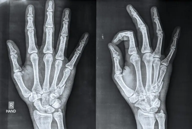 Metacarpal Fractures in Texas Workers’ Compensation